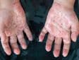 What is Monkeypox? Outbreak sweeps across Europe, but should SA be worried?